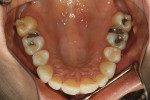 Fig 5. Pretreatment maxillary occlusal view.