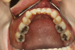 Fig 6. Pretreatment mandibular occlusal view.
