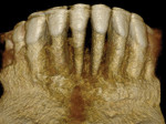 Fig 9. Pretreatment mandibular anterior CBCT scan.