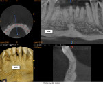 Fig 7. CBCT scan, mandibular arch, anterior segment.
