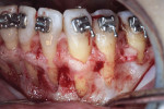 Fig 14. Surgical view, mandibular left, demonstrating dehiscences and fenestrations.