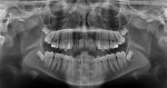 Fig 17. Pretreatment panoramic radiograph, 11-year-old.