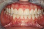 Fig 19. Two-year post-augmentation and corticotomy treatment, depicting a robust mucogingival complex and orthodontic stability.