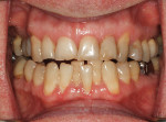 Fig 5. Note overeruption of the teeth Nos. 23 and 25, as well as the right-side cross-bite.