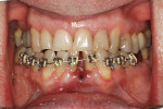 Fig 7. Brackets were placed to facilitate a certain amount of intrusion of the front teeth.