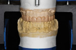 Fig 9. Diagnostic wax-up: design for the esthetic and functional outcome.