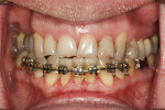Fig 8. At the end of the orthodontic treatment, the incisors are aligned and the incisal position is maintained.