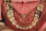 Fig 13. Lower incisors were aligned and leveled.