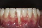 Fig 1. Preoperative photograph showing gingival recession.