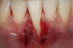 Fig 3. Mesial partial-thickness pedicle flap reflected and sutured to the distal papilla using interrupted sutures.