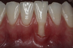 Fig 11. Preoperative photograph showing gingival recession.
