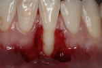 Fig 14. Partial-thickness flap elevated.
