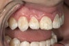 Fig 1. A preoperative photograph shows the wear on the maxillary incisors and lower anterior crowding.