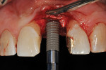 Fig 12. Placement of definitive implant (4.1 mm x 14.0 mm).