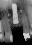 Fig 13. Radiographic image after final implant placement.