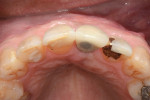 Fig 16. Occlusal view of final crown insertion.