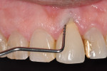 Fig 2. Clinical image of failing tooth No. 9.