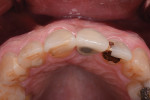 Fig 19. Occlusal view of 3 years postoperative.