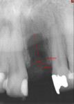 Fig 6. Radiographic image shows a severe vertical bone loss of the middle of the ridge and a maintaining interproximal bone of the adjacent teeth.