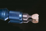 Fig 6. Natural crown bonded to temporary abutment.