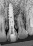 Fig 10. Radiograph of implant in final position.