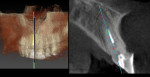 Fig 5. Pretreatment CBCT scan with preplanning for a screw-retained final crown. Sagittal root position noted as Class 1 (key No. 2).