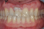 Fig 2. At presentation, protracted view showed composite resin used by a previous dentist to replace the fractured crown.