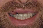 Fig 1. Presentation of a healthy 27-year-old male after a hockey injury and horizontal fracture of tooth No. 8.