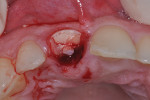 Fig 6. Subgingival and subosseous palatal fracture noted on tooth No. 8.