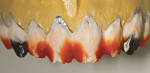 Figure 6  Porcelain was applied to the dentinal area and placed to get some side-effect enamel as well.