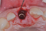 Fig 8. Confirmation of an intact buccal and palatal wall noted; a bone-level tapered 4.1-mm x 14-mm Roxolid®-SLActive® implant (Straumann) placed along the palatal wall of No. 8 with a buccal gap of 3 mm. The implant was placed apically 4 mm from the buccal aspect of No. 8 on the ACSGT (key Nos. 4 and 5). A 20-Ncm insertion torque dictated that an immediate provisional restoration not be fabricated and a transitional removable partial denture was to be used during early healing.