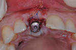 Fig 9. Bone graft of 3-mm buccal gap and palatal SCTG placed in a pouch created facial to the buccal plate and under the buccal flap and sutured, with a tall tapered healing abutment placed (key Nos. 6 and 7).