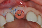 Fig 12. Day of immediate implant placement No. 8: The 10 keys were used with correct 3-dimensional placement with the aid of an anatomically correct surgical guide template, mineralized bone graft of the buccal gap, CTG from the palate placed and sutured under the buccal flap and immediate contour management with a PEEK healing abutment (shown in Figure 11), which will be used during the initial healing phase of 8 weeks. The patient wore a transitional removable partial denture during the 8-week healing phase, followed by a screw-retained provisional crown, which (finalized the transitional zone within) was customized further to create the final transitional zone contour before the final impression in 6 weeks.
