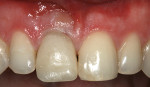 Fig 15. Four weeks after initial provisional placement, modification of the provisional was completed by adding acrylic midbuccal to further support the tissues (key No. 8).