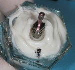 Fig 19. Custom impression coping technique: the provisional was attached to the appropriate implant analog and placed (analog first) into the quick-setting VPS material midway up the buccal aspect of the provisional (note midbuccal marking). After setting, the provisional was unscrewed and the appropriate open-tray impression coping inserted. The space is now filled in with flowable composite. This duplicates the transition zone (key No. 9).