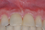 Fig 26. Partial occlusal view shows the convexity of the soft and hard tissues aided by the strict adherence to the 10 keys for excellent final esthetics.