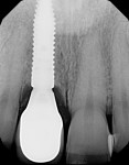 Fig 29. Final periapical radiograph, No. 8 at 1 year. Note favorable bone healing and emergence profile of the final restoration aided by using the 10 keys for successful esthetic-zone immediate mplants. (Periodontist: Dr. Robert A. Levine, Philadelphia, PA; Prosthodontist: Dr. Harry Randel, Philadelphia, PA.)