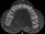 Fig 2. CBCT axial section at coronal third showing 2 palatal canals.
