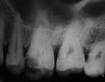 Fig 1. Preoperative intraoral periapical radiograph.