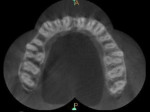 Fig 3. CBCT axial section at middle third showing 2 palatal canals.