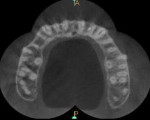 Fig 4. CBCT axial section at apical third showing merged palatal canals.