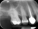 Fig 1. Preoperative periapical radiograph of tooth No. 3 showing moderate vertical bone loss on the mesial surface and moderate horizontal bone loss on the distal. A 6 mm PD is evident on the mesial and an 8 mm PD is present on the distal along with Degree II furcation involvement.