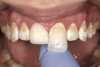 Fig 9. Analysis of the mounted preoperative study models reveals uneven incisal edges.