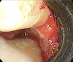 Fig 6. A view of the mesial defect after clean-out consisting of debridement, root planing, and biomodification of the root surface with 24% EDTA.