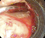 Fig 5. A curette is used to remove the remaining piece of calculus (black arrow). Simultaneous use of the videoscope improves visualization of the surgical site during root planing.