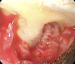 Fig 8. A view of the distal Degree II furcation of tooth No. 3 after clean-out consisting of debridement, root planing, and biomodification of the root surface with 24% EDTA.