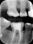Fig 11. 8-month postoperative vertical bitewing of tooth No. 3. Notice almost complete fill of the mesial and distal sites of No. 3.