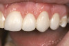 Fig 10. After the selection of the mesio-incisal edge of tooth No. 8 as the correct incisal position, teeth Nos. 7 through 10 are waxed to the platform.