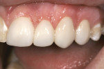 Figure 11  Teeth Nos. 9 through 12 were tried in with a water-soluble try-in paste.