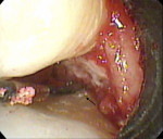 Fig 4. A probe inserted into the defect after removal of granulation tissue shows a measurement of 9 mm from the base of the defect to the CEJ of tooth No. 3. Note the remaining calculus present on the root surface (black arrow).